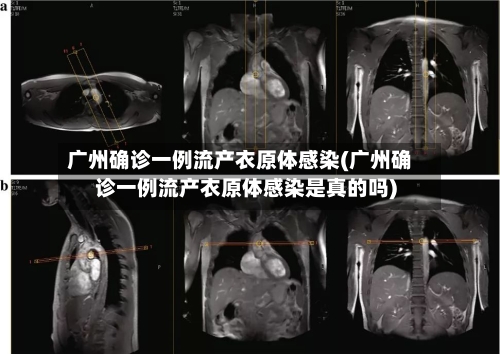 广州确诊一例流产衣原体感染(广州确诊一例流产衣原体感染是真的吗)
