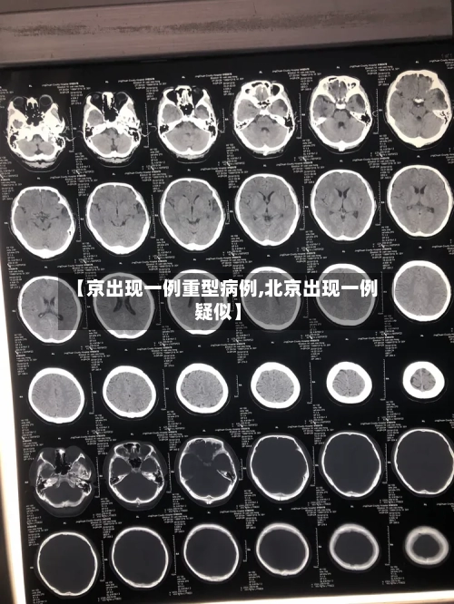 【京出现一例重型病例,北京出现一例疑似】